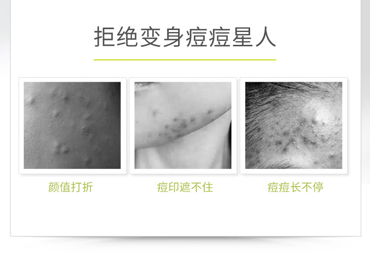 934祛痘凝露男女改善修护净毛孔凝胶男女适用 20ml