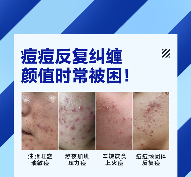 海洋至尊清肌祛痘膏淡化痘印青春豆豆收缩毛孔闭口粉刺凝胶男士 单瓶装20g