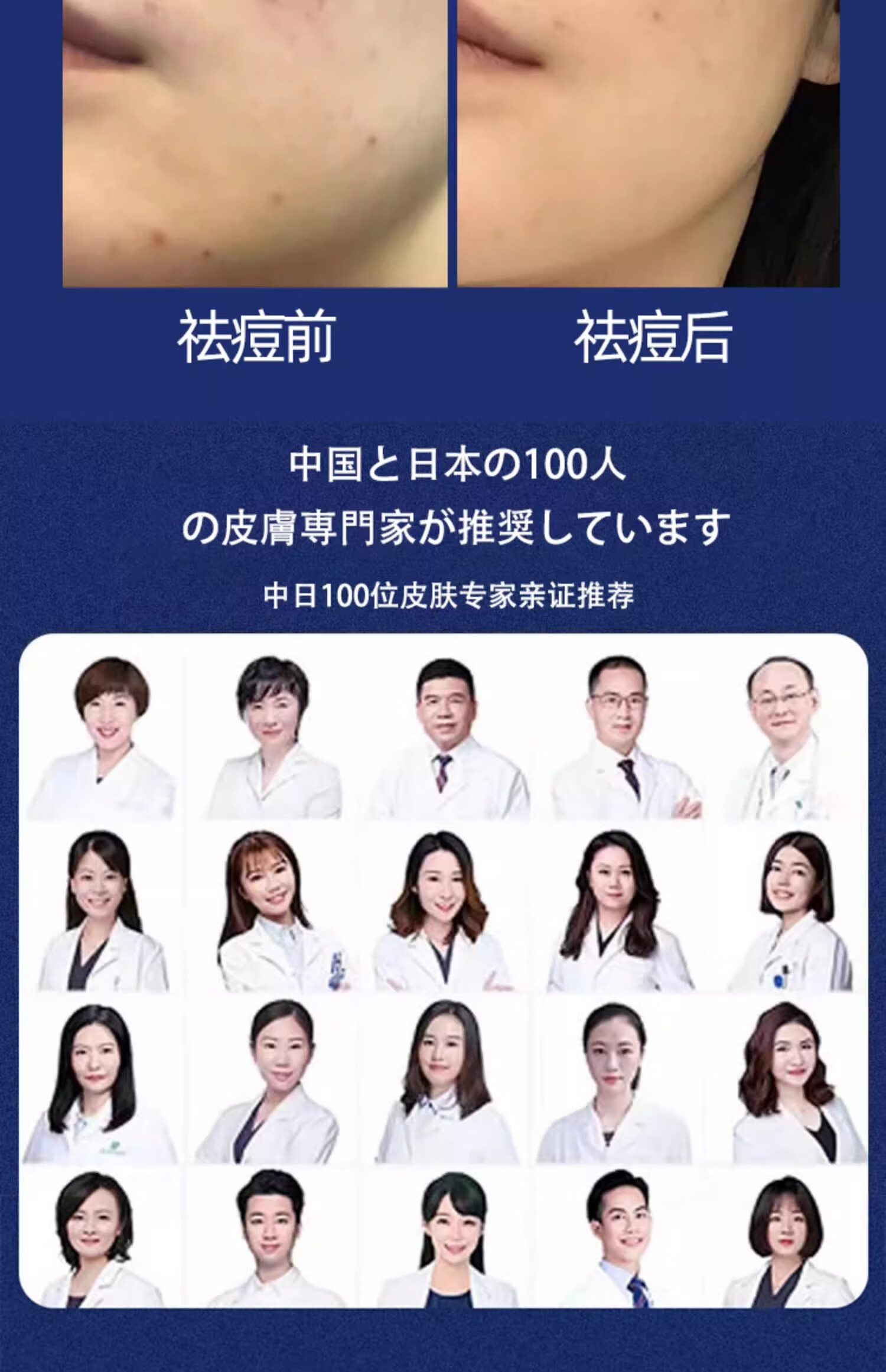 NHFOUYOU祛痘精华液祛痘膏去闭口粉刺痘坑痘印淡化消印收缩毛孔精华液 一瓶【30ml】建议按疗程使用