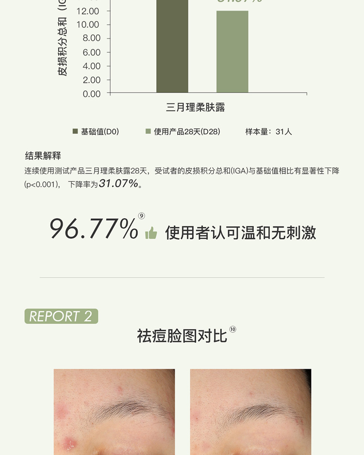 三月理 抗痘柔肤露100ml油痘肌清爽温和祛痘平衡水油痘印男女补水保湿