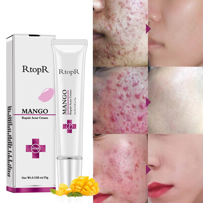 Repair Acne Cream Anti Acne Spots Acne Treatment Scar Blackhead Cream Shrink Pores Whitening Moisturizing Face Skin Care
Repair Acne Cream Anti Acne Spots Acne Treatment Scar Blackhead Cream Shrink Pores Whitening Moisturizing Face Skin Care