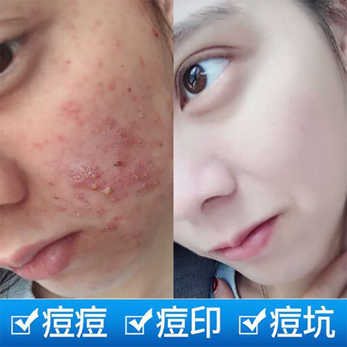 芦荟胶面霜补水保湿晒后修护凝胶控油祛痘淡化痘印男女学生收缩毛孔舒缓滋去疤痕免洗睡眠面膜 拍1发2瓶