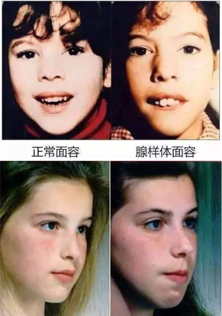 急件发顺丰可开票腺样体肥大面容器防张口呼吸贴嘴巴龅牙套牙齿地包天