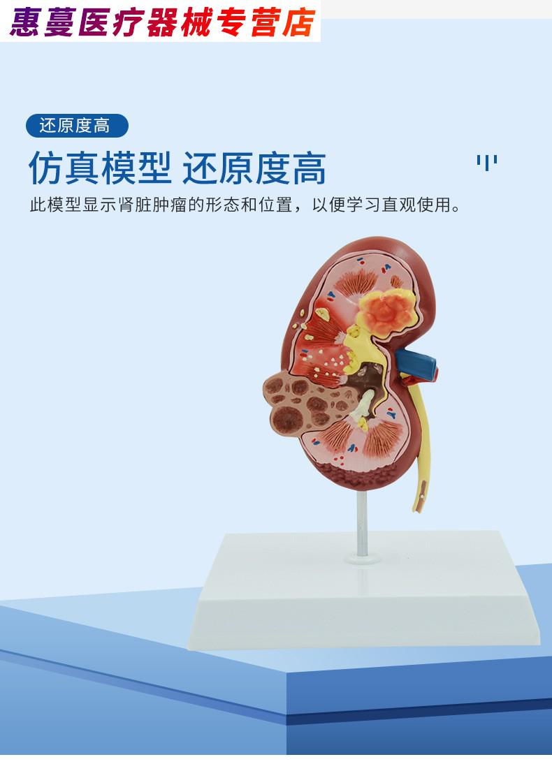人体解剖病理模型器官可拆卸躯干结构肾脏结构病变内脏泌尿科肾小球肾