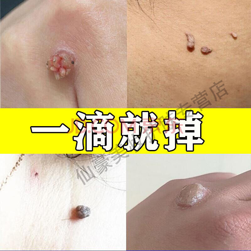 去除脖子小肉粒颈部赘皮赘草温和不留疤 祛丝状尤腋下小猴子