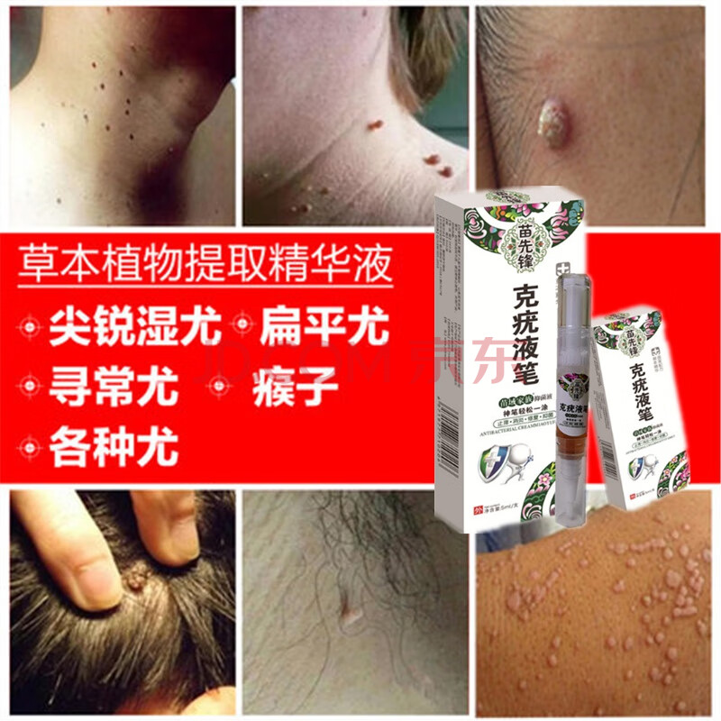 克忧液笔克忧液去丝状扁平疣小肉粒尖锐疣瘊子外用鸡眼刺瘊跖疣脚垫鸡