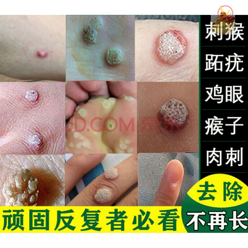 兰润泰康尤克净克忧液丝状疣面部私处脖子上的小肉粒刺猴疣瘊净膏 10