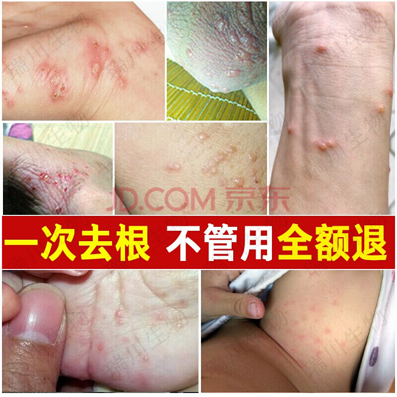 疥疮膏结节一扫光硫磺软膏螨虫皮肤止额痒抑额菌阴囊瘙痒膏去阴虱虫
