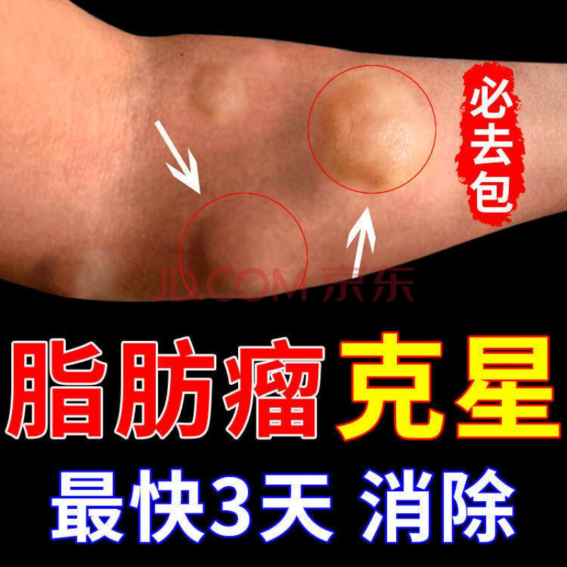 脂肪瘤消贴去除皮下脂肪溜消贴 消瘤膏全身硬块多发性