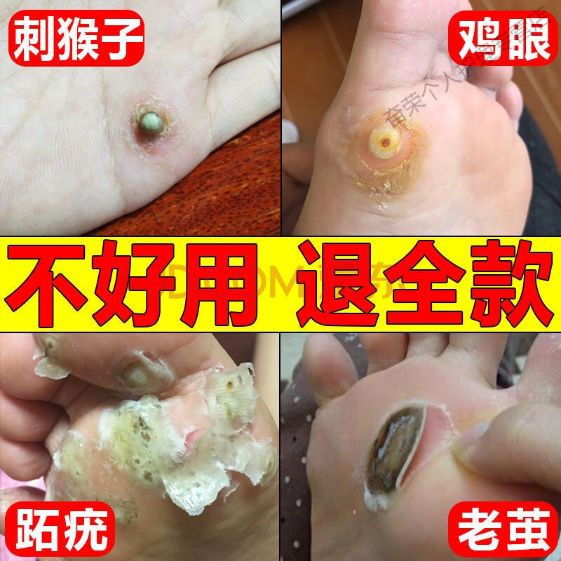 森卓祛跖尢疣瘊猴子止尢犹净足部专用贴肉疵刺去除猴子祛瘊i子净足部