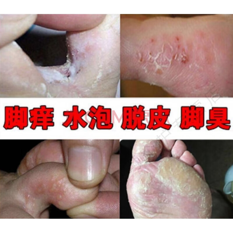 脚趾缝溃烂苗家五毒散治水泡脱皮止痒膏脚趾间烂汗脚祛臭脚痒神器