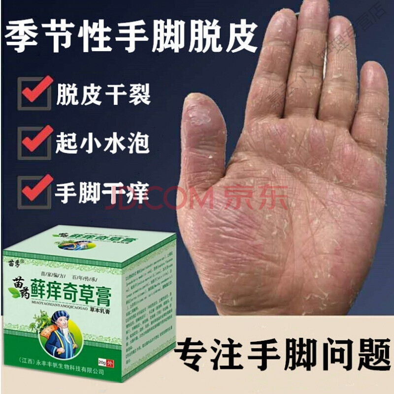 汗泡疹膏手脱皮季节性手上起小水泡汗i孢疹手气型手痒