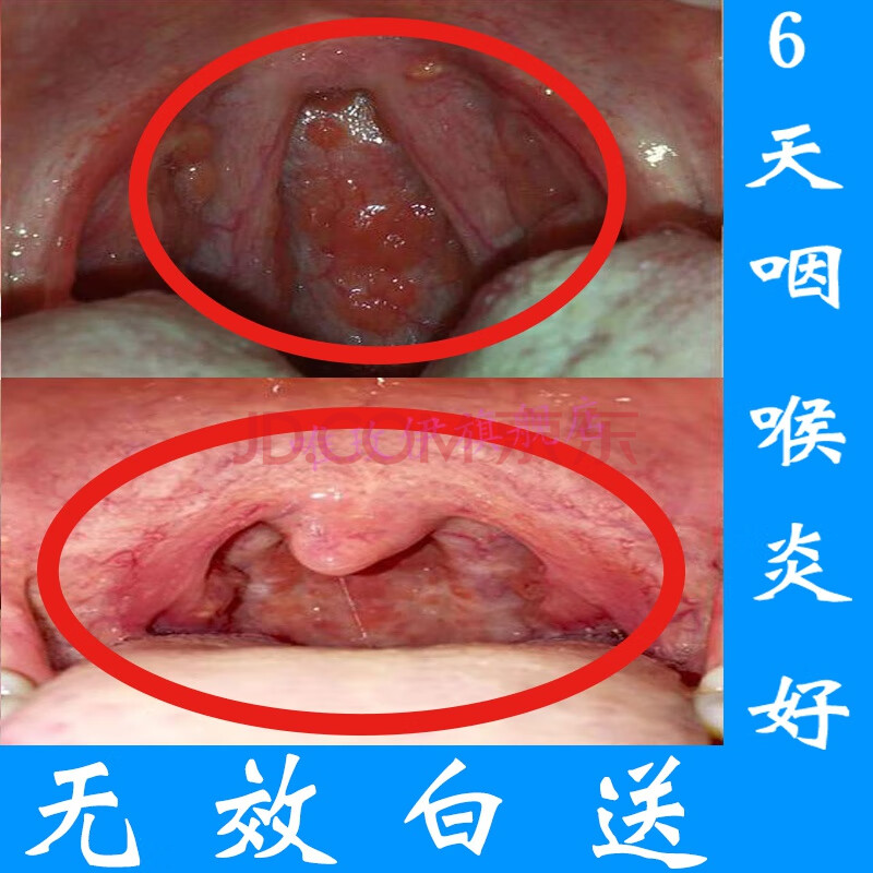 咽炎喷治i疗咽喉炎慢性咽炎喷雾剂滤泡增生异物感止嗑