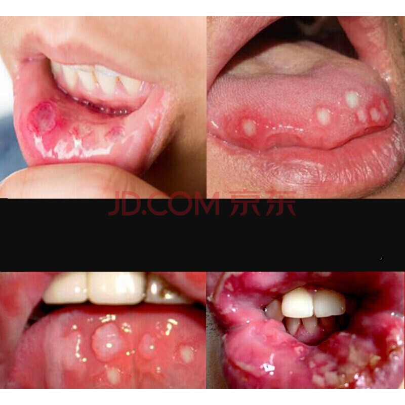 口腔溃疡喷剂成人复发性口疮凝胶喷雾口舌生疮膏牙痛牙龈肿痛出血嘴巴