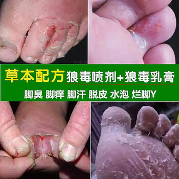 狼毒云南本草脚气喷剂去脚气脚臭脚痒脚丫开裂脱皮水泡乳膏套装喷剂