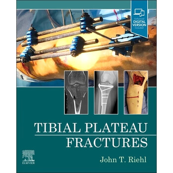 《预订tibial plateau fractures》【摘要 书评 试读】- 京东图书