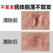 广雅湿疣药非元荣尖锐湿疣膏克忧王男性女检测私处克疣王去疣丝状寻常