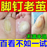 老繭軟化膏繭子去除器腳底厚繭死皮角質(zhì)腳趾關(guān)節繭軟化劑腳后跟硬皮腳掌腳墊手繭子抑菌液 單盒體驗裝