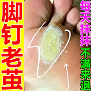 老繭軟化膏繭子去除器腳底厚繭死皮角質(zhì)腳趾關(guān)節繭軟化劑腳后跟硬皮腳掌腳墊手繭子抑菌液 買(mǎi)五發(fā)九【鞏固裝】老顧客回購