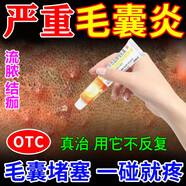 毛囊炎專(zhuān)用特藥頭皮癢止癢毛囊炎頭部專(zhuān)用藥頭上長(cháng)疙瘩發(fā)癢紅腫流膿結痂真菌感染止癢醋酸曲安奈德益康唑乳膏 內服外用組合【本品1+維生素b6片】雙效結合不反復