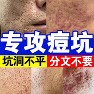 祛痘印淡化消除去痘痘和痘印痘坑修復(fù)男士凹洞填充再生黑色素沉淀 一盒【體驗(yàn)款】