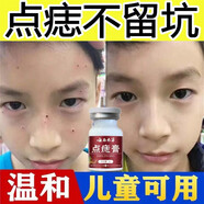 點(diǎn)痣膏無痕正的品 無痛兒童可用臉部點(diǎn)痦子去黑痣祛淡斑專用點(diǎn)痣美容修復(fù)液神器儀祛斑點(diǎn)痣點(diǎn)疣藥水艦旗官方 修復(fù)液+點(diǎn)痣膏組合裝