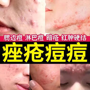 臉上長痘痘專用去痘痘的藥痤瘡膏膿包瘡青春期祛痘印修復(fù)淡化痘印痘坑毛孔粗大學(xué)生醫(yī)用消炎阿達帕林凝膠 【1盒裝】