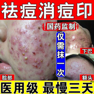 祛痘藥膏淡化痘印想消炎痤瘡專(zhuān)用痘坑修復馬拉色菌毛囊炎膿包紅腫疙瘩閉口粉刺皮膚用藥克林霉素甲硝唑搽劑 七盒【嚴重痘印痘坑痘疤 難以祛除】療程裝