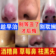 酒糟鼻專用的藥膏紅鼻子真菌草莓鼻去黑頭紅腫紅血絲膿包螨蟲(chóng)粉刺 買五發(fā)十【鉅惠裝】