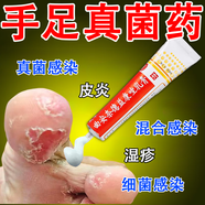 腳氣藥止癢脫皮爛腳丫真菌感染止癢膏治腳氣足癬腳臭腳癢腳出汗起水泡腳縫糜爛瘙癢的藥 曲安奈德益康唑乳膏 本品+足光g散【甄選組合 殺菌治腳氣】