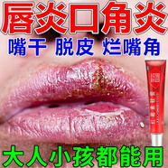 唇炎專(zhuān)用藥慢性唇炎嘴唇干裂脫皮起泡疼痛成人兒童口角炎唇膏修復(fù)潰爛起泡出血 紅霉素軟膏 1盒裝【干裂脫皮疼痛】