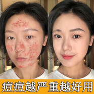 粉嫩公主 駐顏祛痘膏組合套裝產(chǎn)品痘印青春痘霜貼粉刺凝膠痤瘡酒刺痘痘肌 痘痘膏2瓶+蝦青素1瓶+洗面奶1瓶