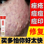 九芝集南同祛痘膏淡化痘印痘坑修復(fù)男女士改善粉刺閉口痘痘和痘印 三盒周期裝