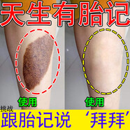 胎記去除膏神器去胎記臉部黑色素太田咖啡斑淡化老年黃褐雀斑紅胎記遺傳胎記全身胎記祛除膏 買三送二【免費試用】發(fā)5盒