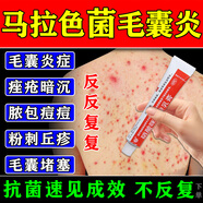 馬拉色菌毛囊炎抗真菌藥膏 手臂胸前長(cháng)疙瘩膿包后背長(cháng)痘痘祛痘專(zhuān)用藥 毛囊炎用什么藥膏 硝酸咪康唑乳膏 五盒裝【告別毛囊炎】一步到位