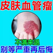 血管瘤專(zhuān)用凝膠嬰兒專(zhuān)用非藥非去除皮膚外用紅痣血管瘤櫻桃草莓狀血管瘤紅血絲修復(fù)軟膏 買(mǎi)二發(fā)三【療程裝】多數(shù)人的選擇