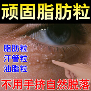 去除眼周白色顆粒脂肪粒去膏油脂粒眼睛脂肪粒汗管瘤小丘疹眼霜L 買三送二