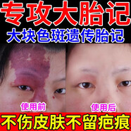 胎記去除膏神器去胎記臉部黑色素太田咖啡斑淡化老年黃褐雀斑紅胎記遺傳胎記全身胎記祛除膏 買二送一【免費試用】發(fā)3盒