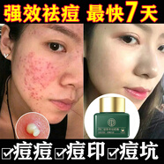 同仁堂祛痘膏去痘痘淡化痘印坑初高中生男女學生改善粉刺閉口青春痘20g 3盒長期爆痘用戶【買二送一】