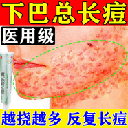下巴長(cháng)痘痘祛痘藥膏維A酸乳膏祛痘消炎痤瘡專(zhuān)用淡化痘印內分泌失調調理男女臉上長(cháng)痘痘修復消炎痘印閉口粉刺 3盒裝【紅腫疙瘩閉口粉刺 膿包痤瘡)