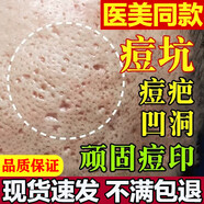 祛痘印淡化消除去痘痘和痘印痘坑修復(fù)男士凹洞填充再生黑色素沉淀 三盒【無(wú)校包退】買二送一