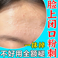閉口粉刺克星臉上起小疙瘩閉口粉刺臉部逆光疹閉合粉刺額頭痘痘 單盒裝