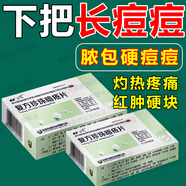 痤瘡專用藥口服祛痘斑藥毛囊炎青春痘痤瘡閉口粉刺膿包瘡滿臉痘痘背上長痘下巴長痘  復(fù)方珍珠暗瘡片 學(xué)生黨祛黑祛痘福音本品*5+阿達(dá) 藥房當(dāng)日發(fā)貨國藥準(zhǔn)字
