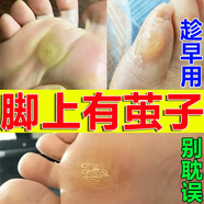 老繭軟化膏繭子去除器腳底厚繭死皮角質(zhì)腳趾關(guān)節繭軟化劑腳后跟硬皮腳掌腳墊手繭子抑菌液 買(mǎi)三發(fā)五【周期裝】長(cháng)期老繭