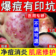喬記本草醫(yī)用的面膜祛痘消炎痤瘡專用祛痘修復面膜去痘痘和痘印面膜械字號 3盒【買2送1】祛痘 痘坑痘疤/修復