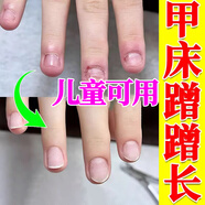 兒童咬指甲甲床修復生長(cháng)液兒童啃咬甲床分離促進(jìn)甲床快速生長(cháng)矯正手腳指甲變空防倒刺去邊緣死皮營(yíng)養液油 買(mǎi)3送2【紅潤有光澤】