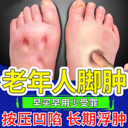 老年人腳腫專用噴劑可搭腳腫消腫藥老年人水腫消腫專用浮腫腳疼用 5盒鞏固裝重度腫痛 頑固反復(fù)