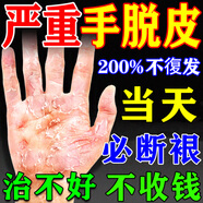 手足脫皮藥膏手指手掌脫皮嚴重脫皮真菌感染蛻皮干燥起皮脫皮開(kāi)裂 9盒【告別手指脫皮】斷裉裝