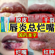唇炎唇膏專(zhuān)用藥慢性唇炎嘴唇干裂脫皮去死皮角質(zhì)護(hù)理無(wú)激素唇炎膏小孩舔嘴唇兒童嘴唇周?chē)t腫癢痛紅霉素軟膏 1盒 抗菌消炎止癢