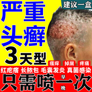 鹽酸特比萘芬噴霧劑頭癬特新效期藥真菌感染頭皮屑瘙癢頭皮癬蘚頭皮毛囊炎頭皮癢癢脂溢性皮炎專用藥皮膚用藥 1盒【治療頭癬噴劑】